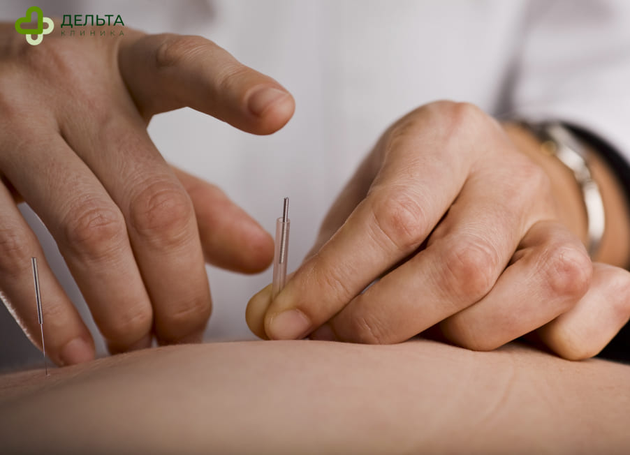 Человеку делают иглоукалывание